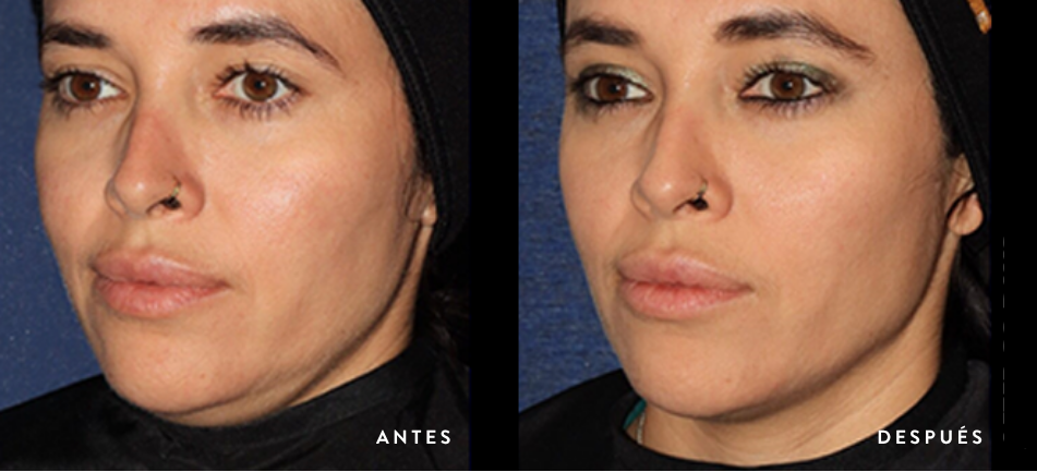 Antes y después Ultherapy Prime caso 2